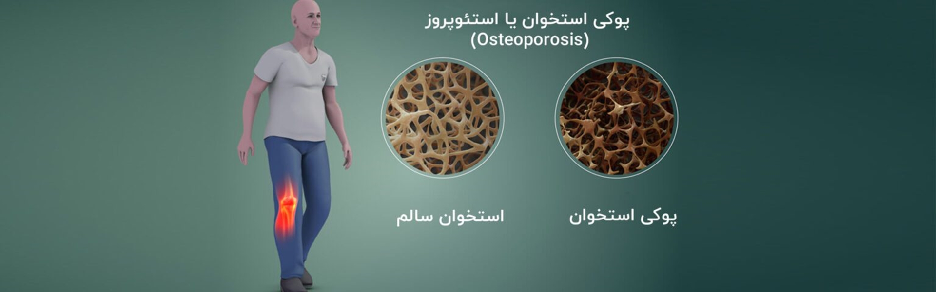 شعار روز جهانی پوکی استخوان (بی‌توجهی به سلامت استخوان را متوقف کنیم)